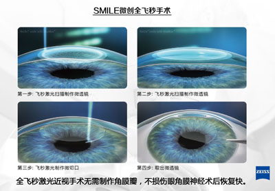 準(zhǔn)分子激光和飛秒激光的區(qū)別？