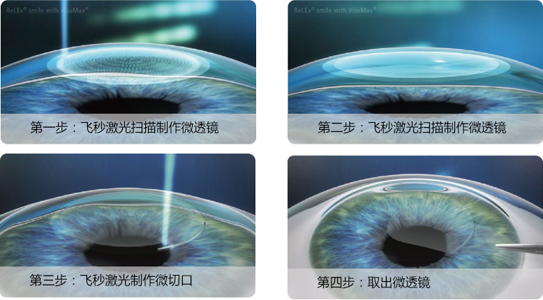 “叁.11近視手術(shù)節(jié)”與你相約 哈爾濱普瑞眼科醫(yī)院”