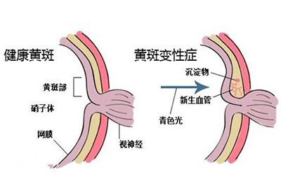 黃斑變性的三個要點