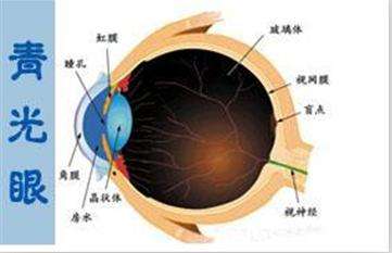 青光眼手術(shù)的費用多少？