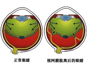 視網(wǎng)膜脫離的癥狀及方法