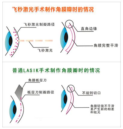 眼睛散光是怎么回事?普瑞眼科專家解析散光